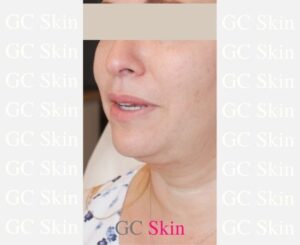 GC Skin Medspa Kybella Before