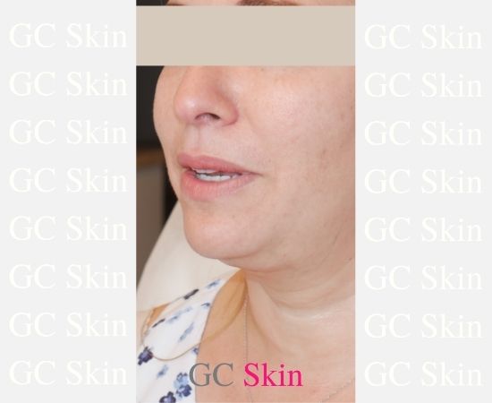 GC Skin Medspa Kybella Before