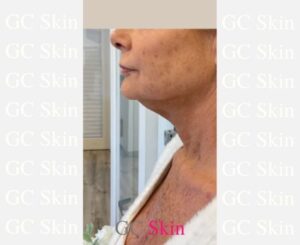 GC Skin Medspa Necklift Before