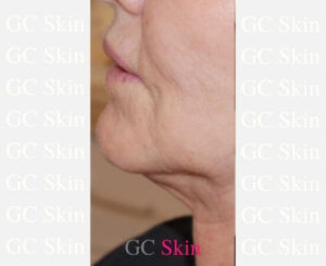GC Skin Medspa Skin Tightening Before