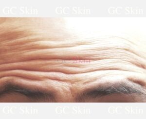 GC Skin Medspa Botox Before