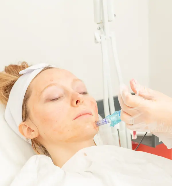 PRP microneedling GCSkin