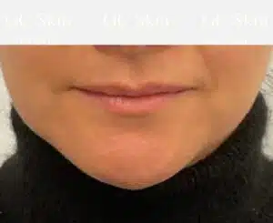 GCSkin Fillers Case 2