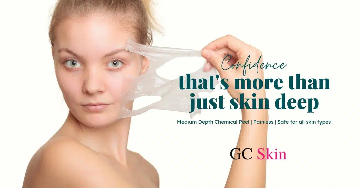 VI Peel in Sherman Oaks: The Ultimate Skin Rejuvenation at GC Skin Medspa